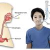 Nasogastric Tube