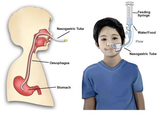 Nasogastric Tube