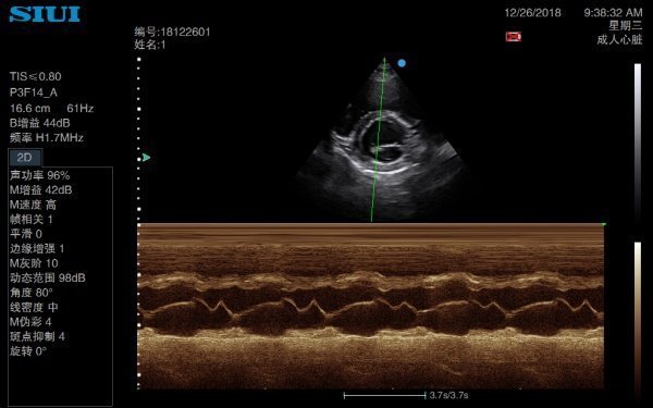 SIUI CTS-5000 Digital 4D Color Doppler Ultrasound Machine