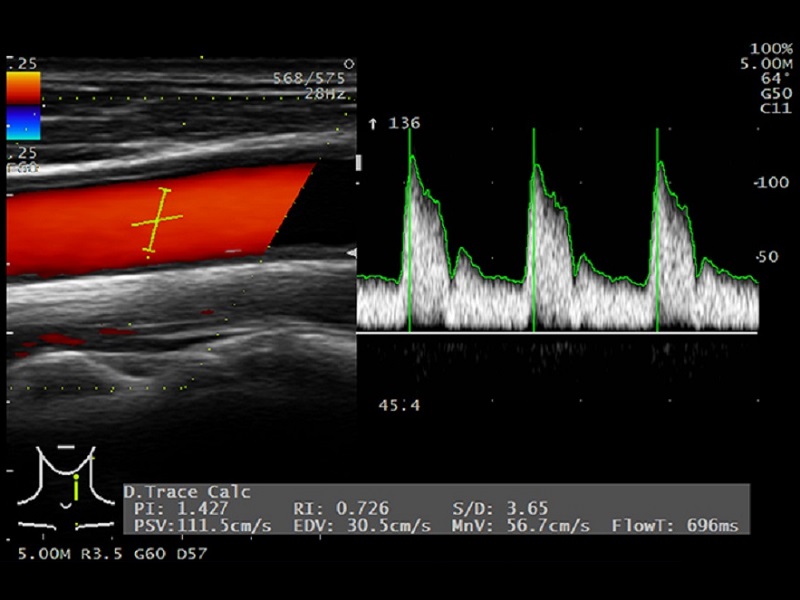 AR50 Doppler Auto Trace