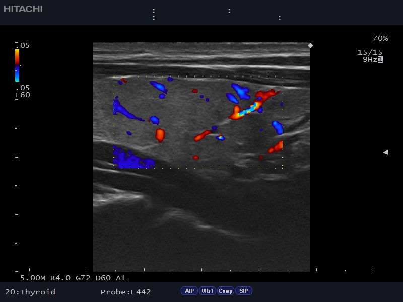 AR50 Thyroid