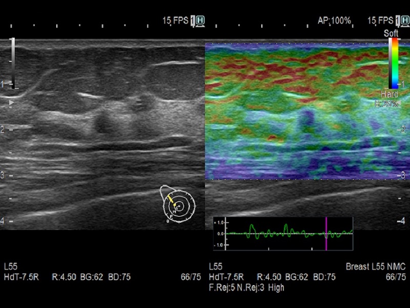 AR65 Breast RTE