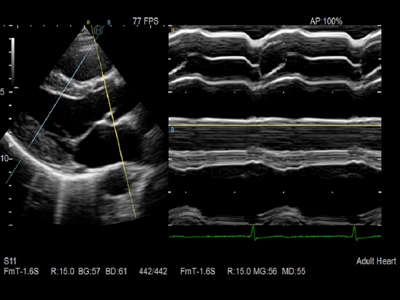 AR65 Cardio M mode