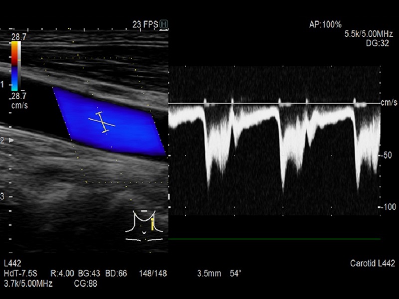 AR65 Vascula Carotid Dop