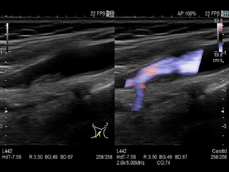 AR65 Vascular Carotid Dual CF