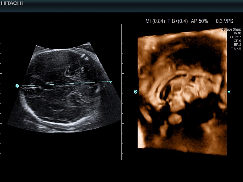 AR750 Fetal corpus callosum in the central nervous system CNS in multiple planes CMPR