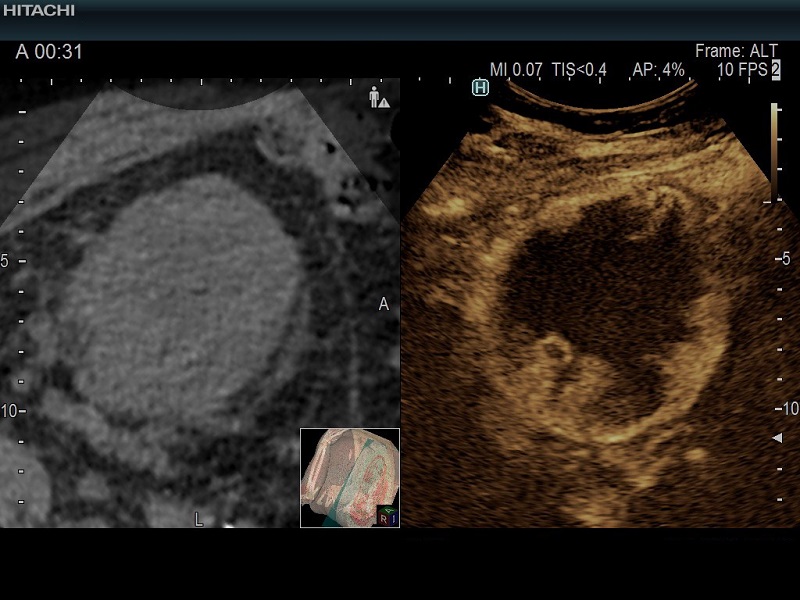 AR750 Needle guidance for biopsy of kidney tumor with contrast