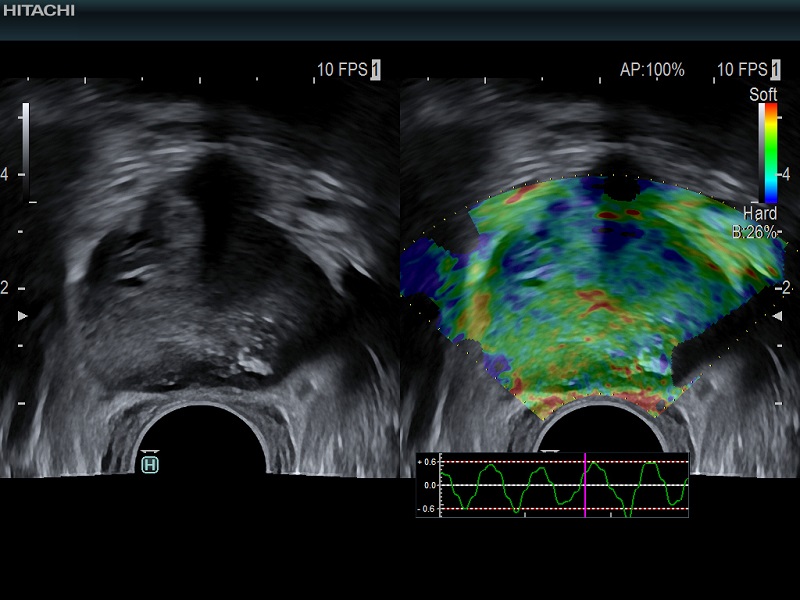 AR750 Prostate with elastography